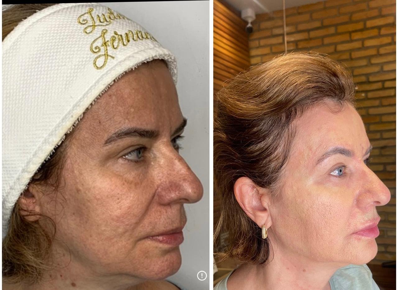 Antes e depois: harmonização com naturalidade