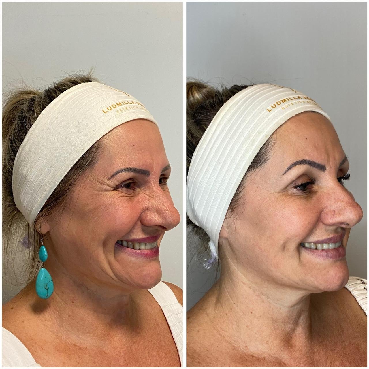 Antes e depois: resultado real na Pelissari